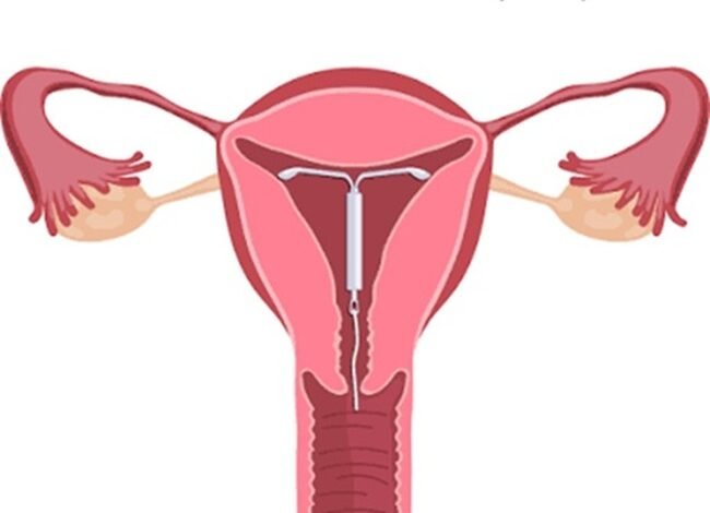 Can IUD change your menstrual cycle? Here’s what we know